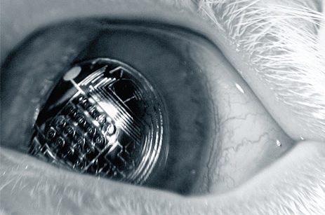 Argumented Reality kontaktlinse. Foto: University of Washington